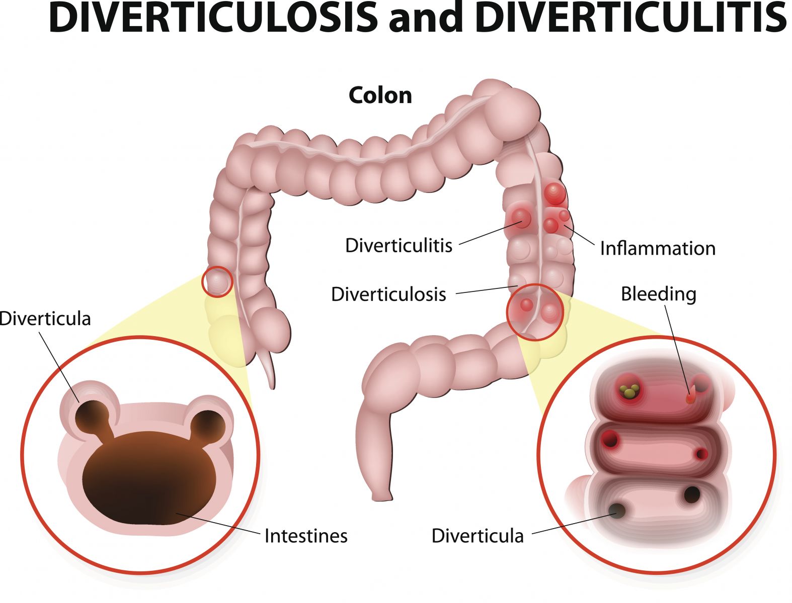 How Long To Stay On Liquid Diet For Diverticulitis Diet Poin   Diverticulosis And Diverticulitis GettyImages 534107411 